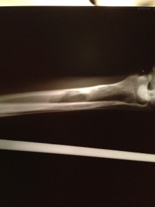 osteosarcoma visible in x-ray